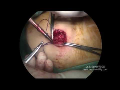 Single Incision Laparoscopic Surgery using Common Laparoscopic Instruments