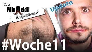 Das Minoxidil Experiment #Woche11 |  Vorher Nachher, Allergieupdate und Schattenseiten