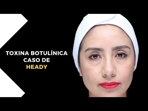 Caso de HEADY: Toxina botulínica
