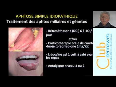 Aphtes et ulcérations aphtoïdes