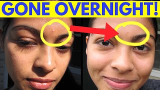 Reduce Pimple Inflammation Overnight!