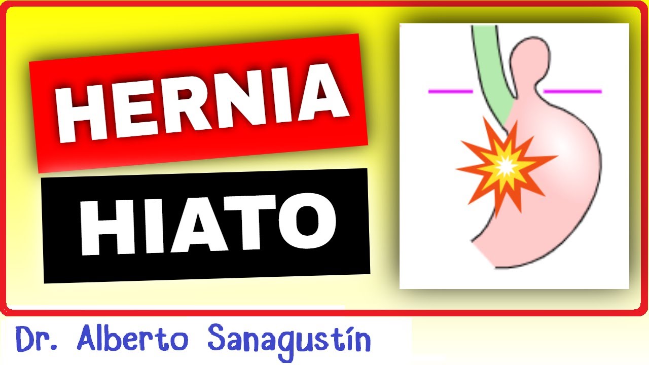 HERNIA DE HIATO 💥 Causas, Síntomas, Clasificación y Tratamiento