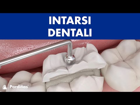 Intarsi dentali ©