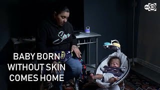 Download lagu Baby born without skin goes home after 11 months in hospital mp3 Download lagu Baby born without skin goes home after 11 months in hospital mp3