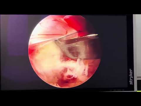 Endoscopic spine surgery using Navigation +O arm-How is the Surgery performed? 