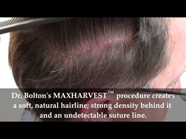 Patient 34 Undetectable Scar: 4mo