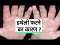 हथेली फटने का कारण हथेली फटने का इलाज Ha