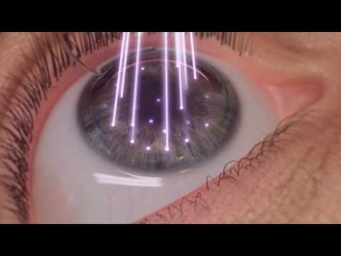 Cirugía refractiva con láser de femtosegundo