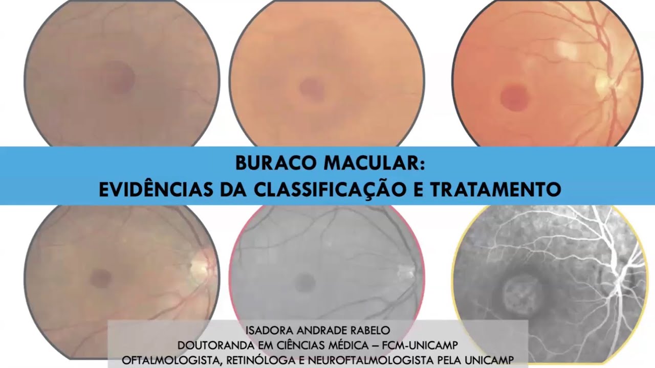 Retina e Vítreo (07/11/2024) - Buraco Macular: Evidências da Classificação e Tratamento