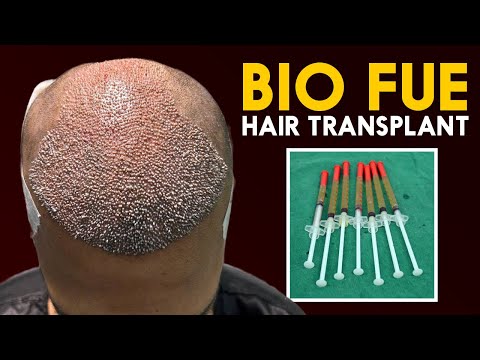 BIO FUE Hair Transplant | Future Hair Transplant Techniques |