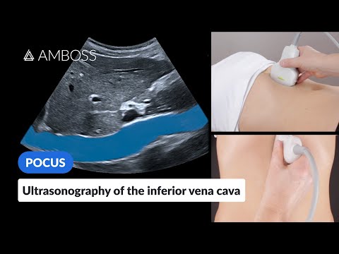Point of Care Ultrasound of the Inferior Vena Cava (IVC) - AMBOSS Video