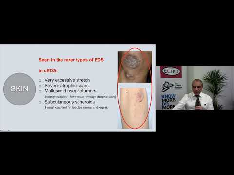 Virtual Summer Conference 2020: ¿Qué es SED Tipo Hipermóvil? by Dr. Alan Hakim | Spanish (ES)