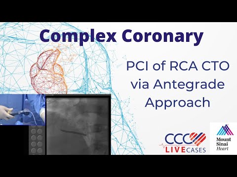 PCI of RCA CTO via Antegrade Approach - CCC Live May 2016