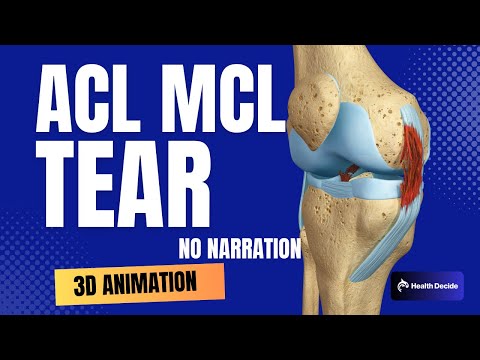 ACL (Anterior Cruciate Ligament) MCL (Medial Collateral Ligament) Tear and Repair (No Narration)