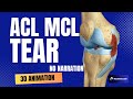 ACL (Anterior Cruciate Ligament) MCL (Medial Collateral Ligament) Tear and Repair (No Narration)