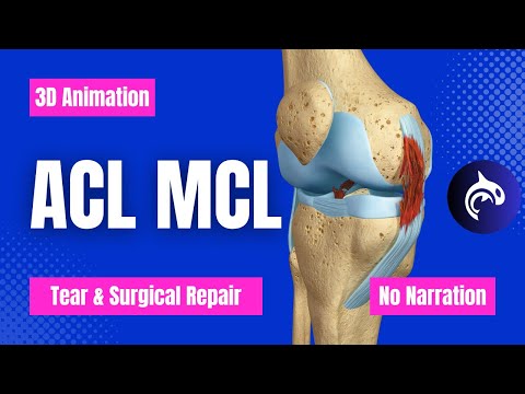 ACL Anterior Cruciate Ligament MCL Medial Collateral Ligament Tear and Repair No Narration
