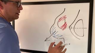 ¿POR QUÉ ALGUNOS SENOS SE VEN DEFORMES elcirujanodelasreinas