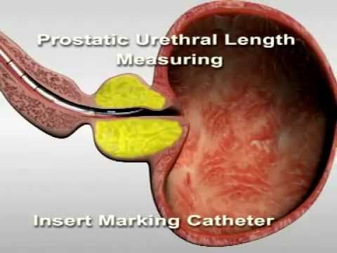 Ordnung und Prostata Ultraschall Durchführung Könnte es ein Ausschlag am Körper der Prostata sein