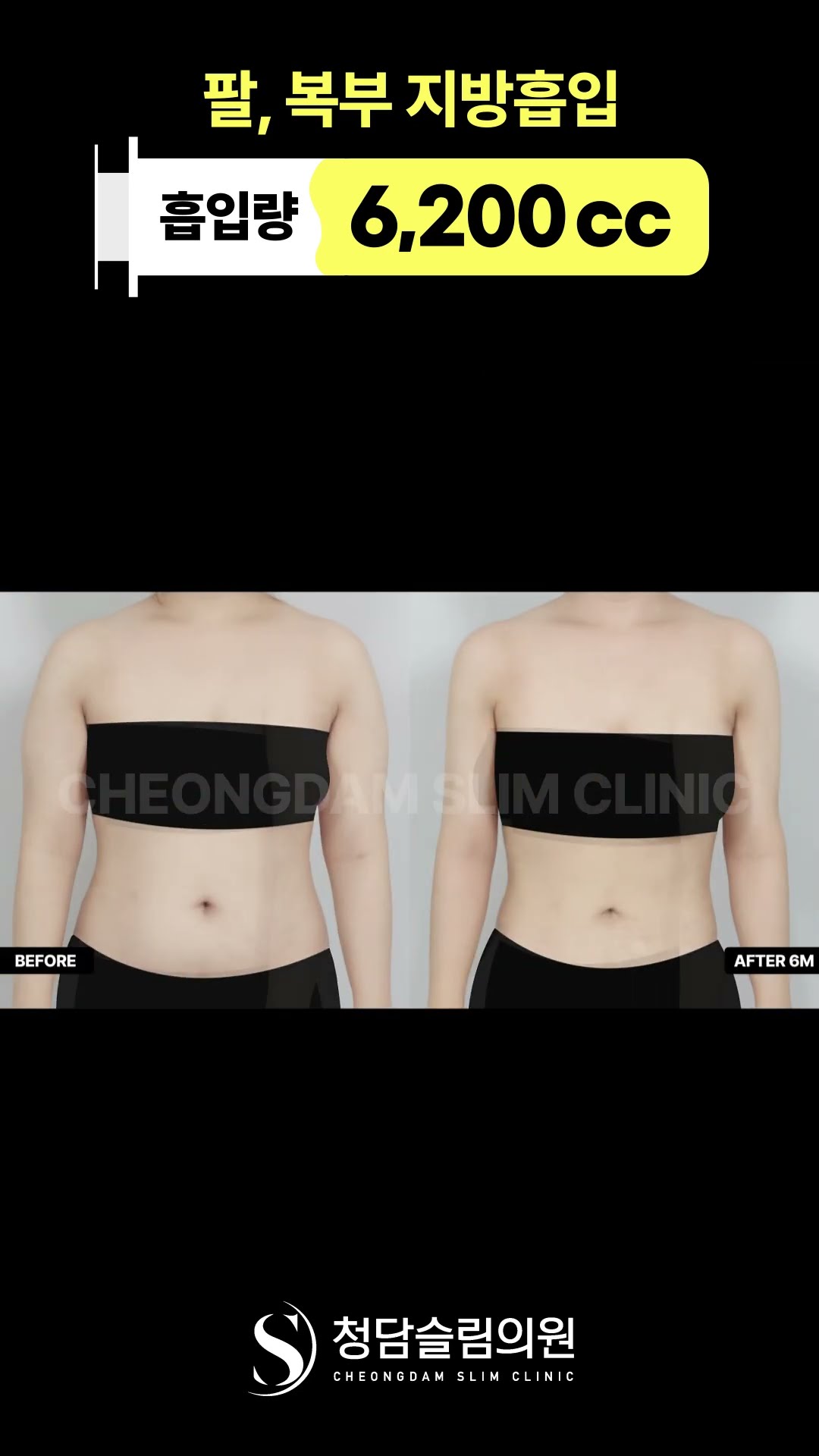 결혼 전 상체지방흡입, 드레스입을 준…