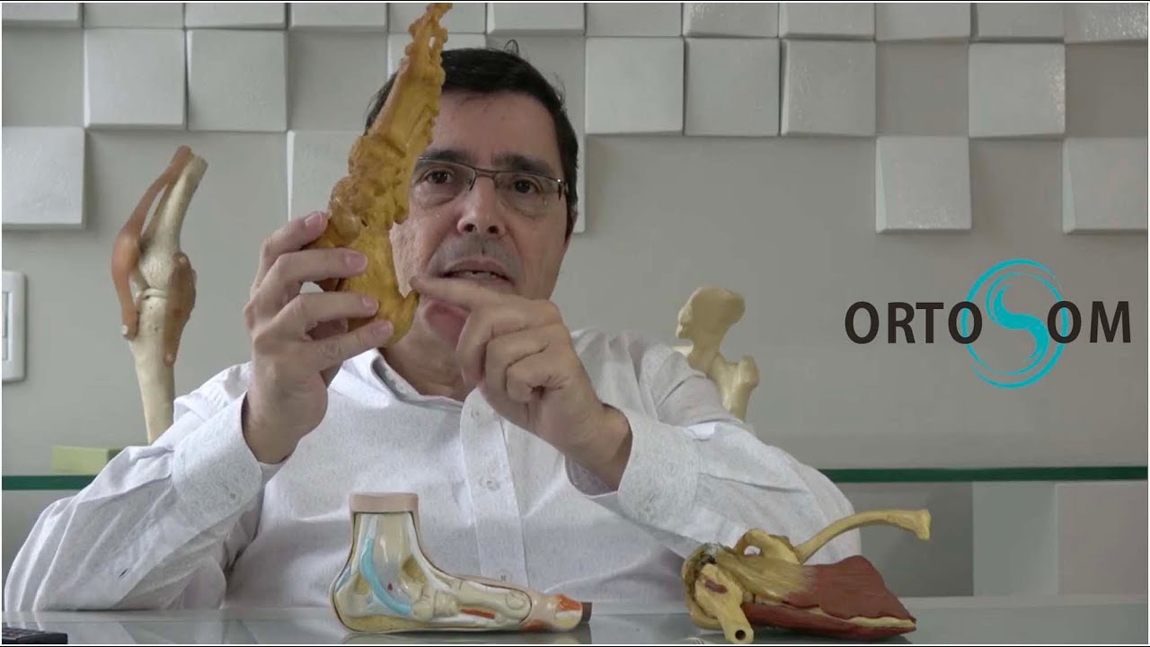 Calcificações dolorosas nos tendões e os esporões  tem que ser removidas para alívio da dor?