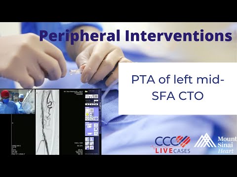 PTA of left mid- SFA CTO - Peripheral Interventions August 28, 2013
