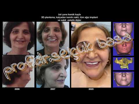 Kemik kaybı tedavisi ve implant