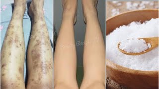 how to remove mosquito bite marks from legs with salt | Remove Dark spots on leg fast Natural, Scar