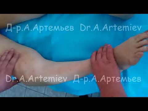 Операция по замене коленного сустава реабилитация отзывы Остеохондроз иголки в ногах