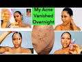 HOW I GOT RID OF MY DARK SPOTS ACNE PIMPLES WITH THIS 3 PRODUCTS Achieve Clear Skin Fast