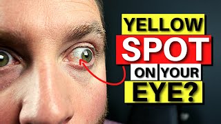 Yellow SPOT On Your Eye? - Pinguecula Explained