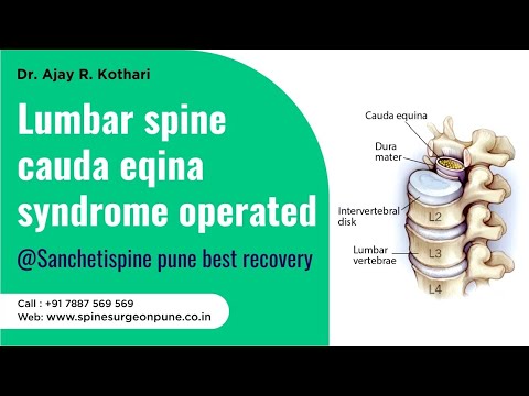 Patient Testimonials | Dr. Ajay Kothari - Spine Surgeon | Shivaji Nagar, Pune