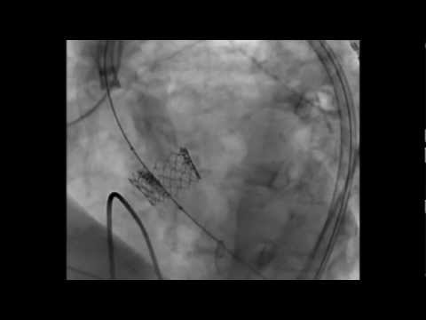 Edwards SAPIEN Transcatheter Heart Valve Deployment - TAVR
