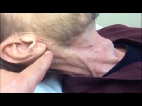 Jugular Venous Distention on Physical Examination