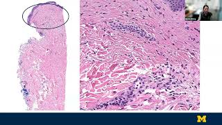 Vascular Diseases and Non-Infectious Granulomatous Dermatoses By Grace Wang, MD