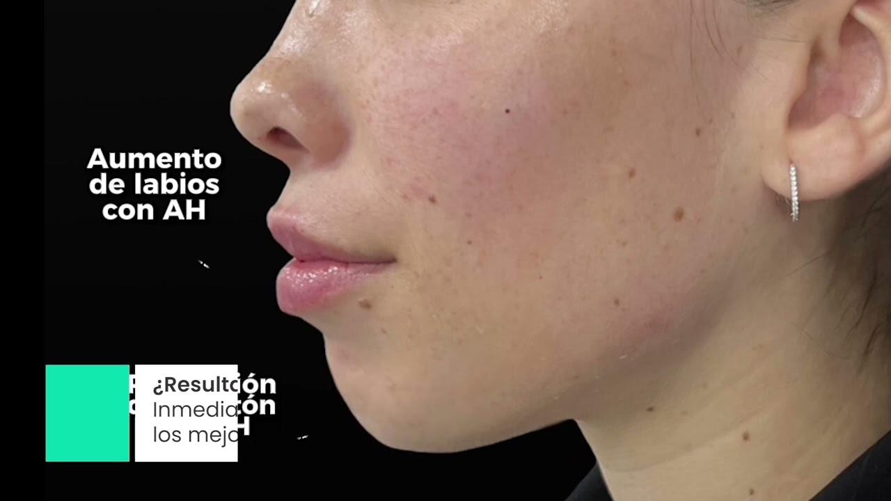 Video de rejuvenecimiento facial en Rogans
