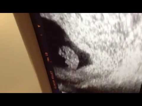 Ecografía de 8 semanas de embarazo