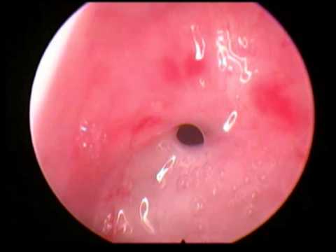 subglottic stenosis,6yr,postvent