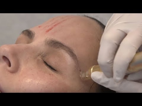 Vampire Facial (Microneedling w/ PRP)  | Between The Before & After Ep. 3 | NewBeauty