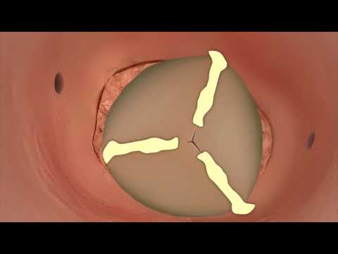 What is aortic stenosis?