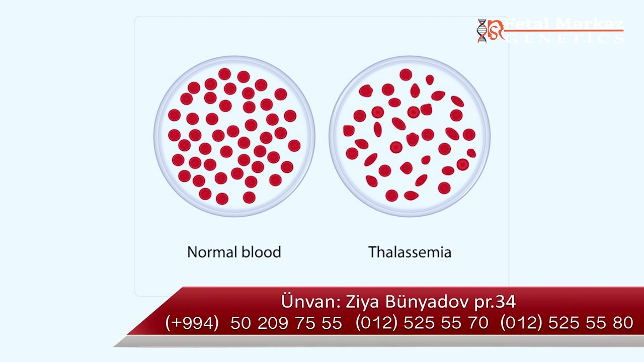 Uşaqlarda ANEMİYA nədir və əlamətləri nələrdir?