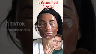 THIS IS CRAZY - Extreme Phenol Peel For Acne Scarring