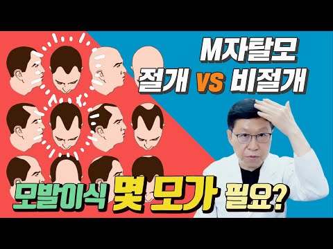 介绍M字脱发发线头发移植需要几毛、切开法、非切开法选择标准。