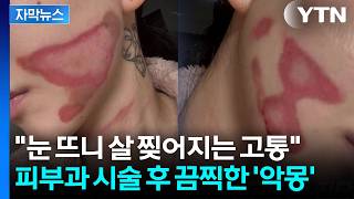 [자막뉴스] 얼굴 양쪽 심각한 상태...한예슬 이어 AOA 권민아도 '의료사고' / YTN