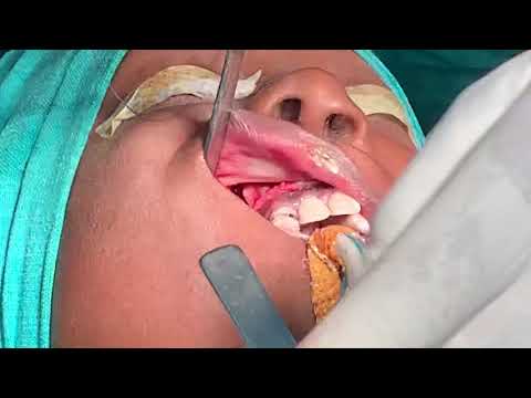 Suturing Up After Upper Jaw Surgery To Create New Bone