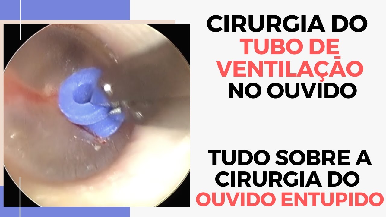 Como melhorar sensação de ouvido tampado: Cirurgia do tubo de ventilaçāo ou do carretel