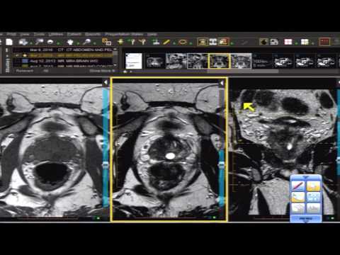 népi módszerek krónikus prosztatitis prostate cancer symptoms early