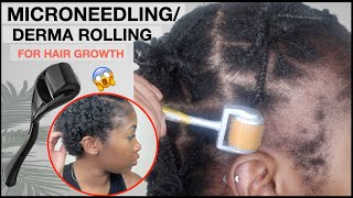 MICRO-NEEDLING/DERMA ROLLING FOR EDGE GROWTH  | Two Month Update | TRACTION ALOPECIA 🚨 NO MINOXIDIL