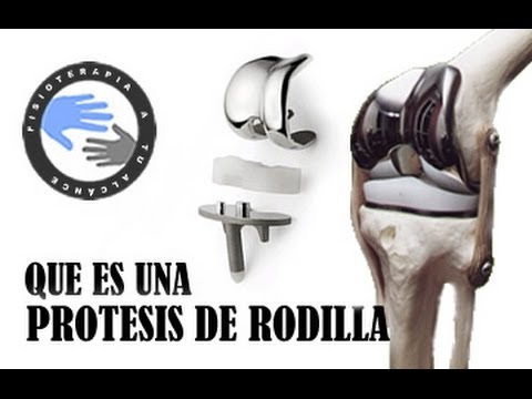 Protesis de rodilla completa, que es