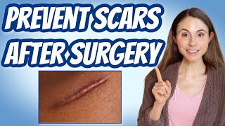 HOW TO PREVENT SCARS AFTER SURGERY 💉 DERMATOLOGIST @DrDrayzday