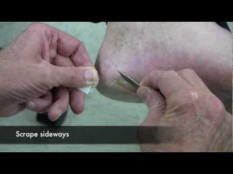 Skin Scraping for Fungal identification